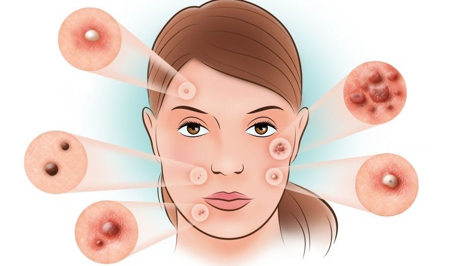 7 dicas caseiras para eliminar acne naturalmente que você tem que usar