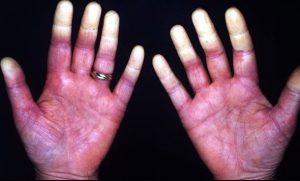 Síndrome de raynaud: o que é, causas, sintomas e tratamentos