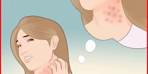 como usar vinagre para tratar eczema?