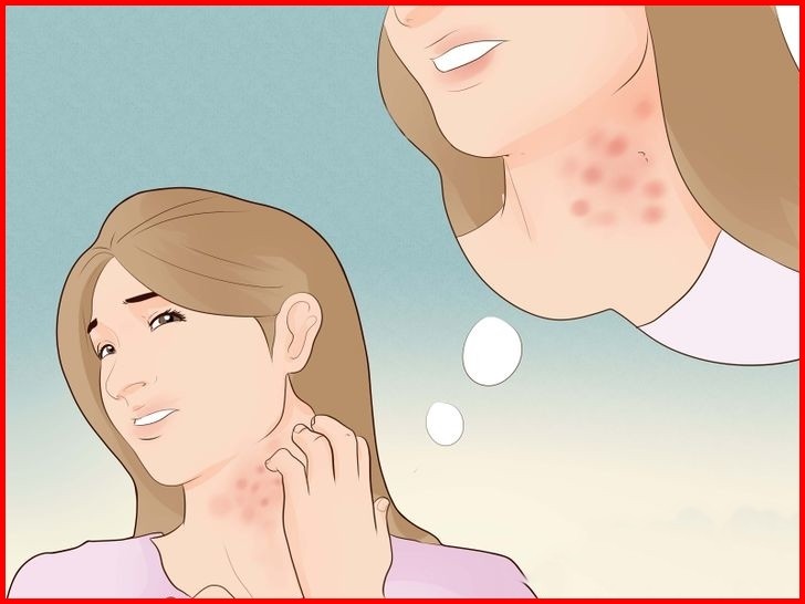 como usar vinagre para tratar eczema?