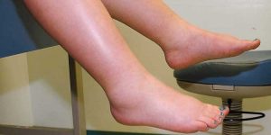 dicas caseiras para curar edema nas pernas