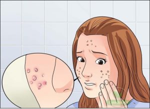 Receitas com sal de epsom para eliminar acne: funciona? como usar?