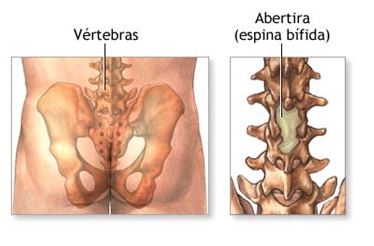 Espinha bífida: o que é, causas, sintomas e tratamentos