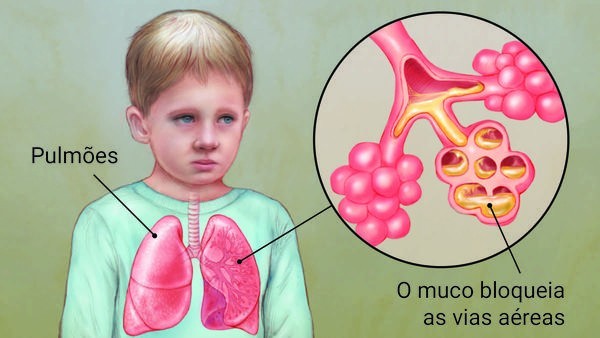 fibrose cistica