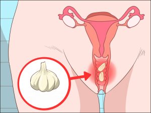 Remédios caseiros para eliminar os fungos vaginais: dicas e receitas