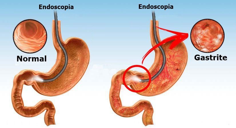 Gastrite: causas, quais os tipos, sintomas, tratamentos e como prevenir