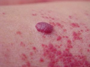 Hemangioma: o que é, causas e tratamentos