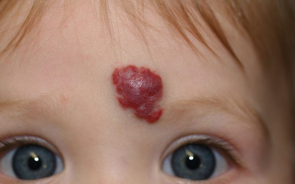 Hemangioma - O que é, Causas e Tratamentos! | Cura Natural