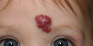 hemangioma