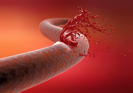 7 sintomas da hemofilia e tipos do distúrbio