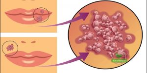 receitas caseiras para acabar com a herpes labial