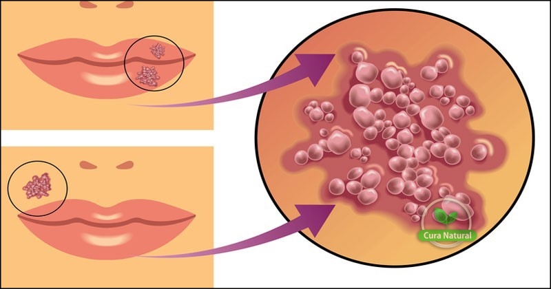 receitas caseiras para acabar com a herpes labial