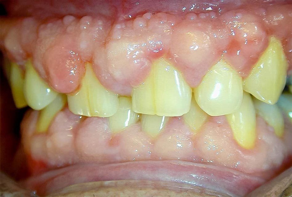 Hiperplasia gengival: o que é, causas, sintomas e tratamentos