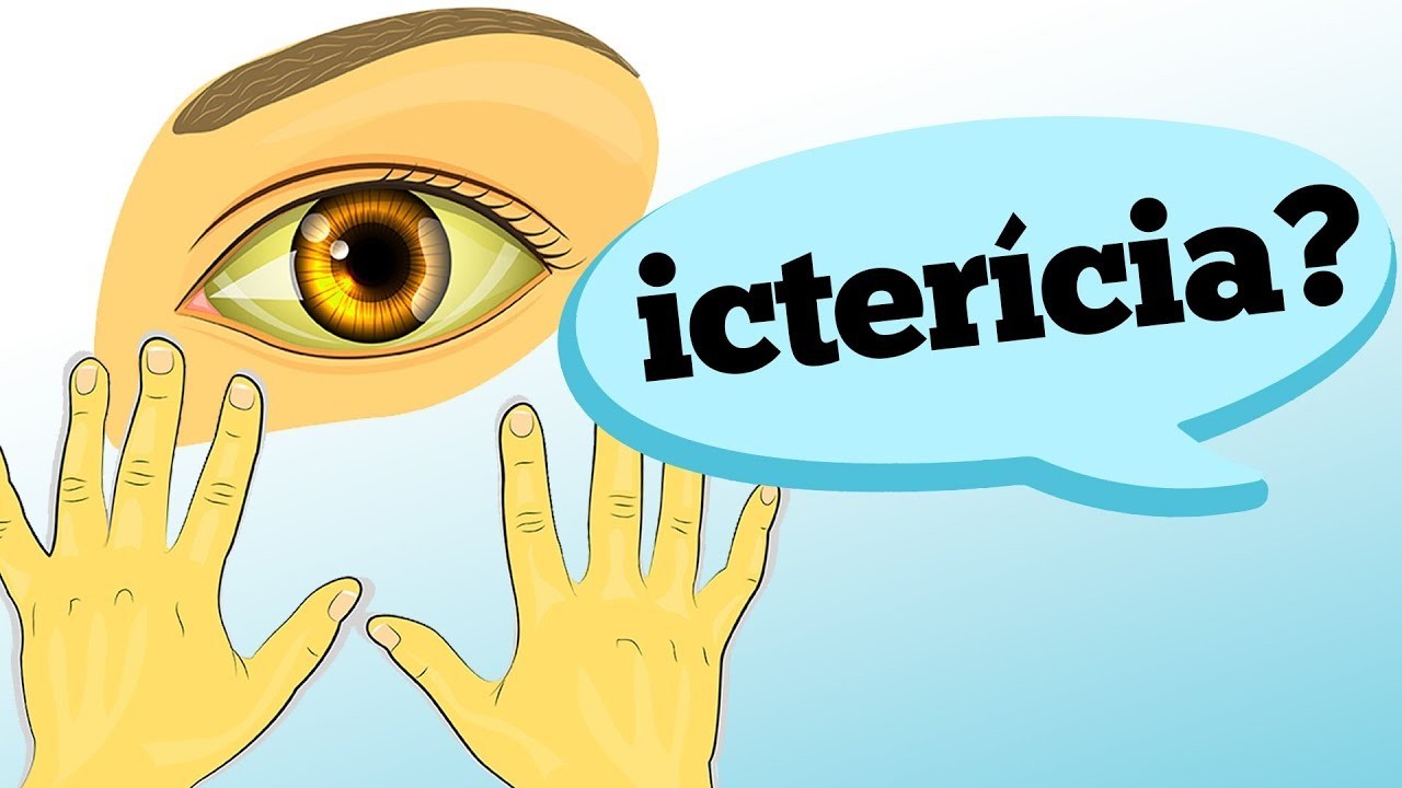 ictericia