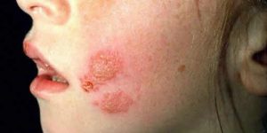 tipos de impetigo, sintomas e tratamentos