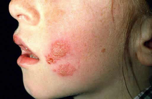 tipos de impetigo, sintomas e tratamentos