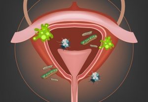 Infecção urinária: o que é, causas, sintomas e tratamentos