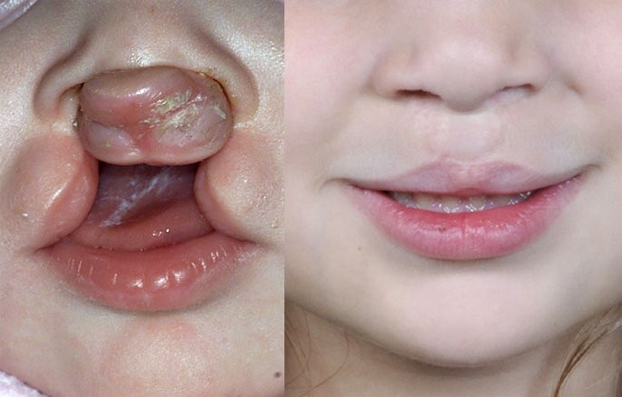 Lábio leporino: o que é, causas, sintomas e tratamentos