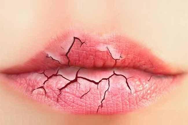 10 dicas caseiras para acabar com os lábios rachados que mulheres usam