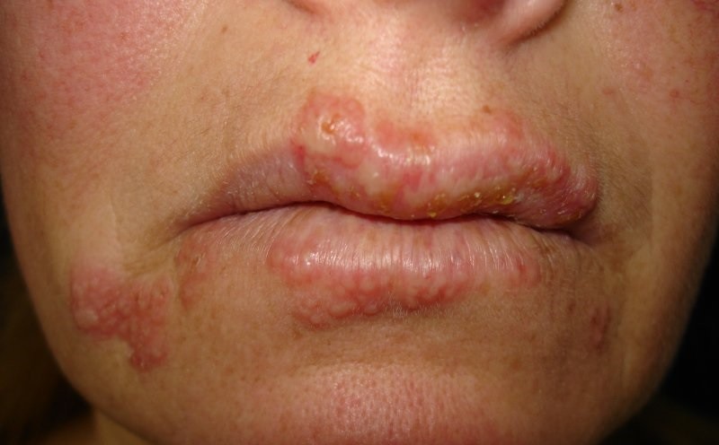 Receitas caseiras para acabar com a herpes labial: funciona? como usar?