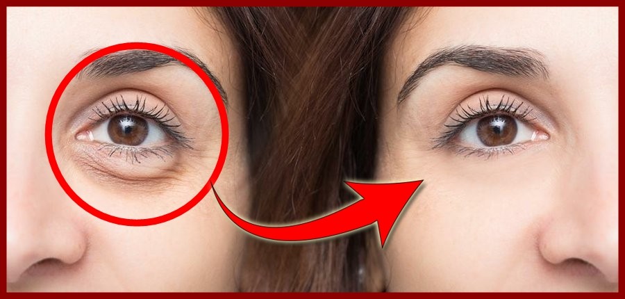 Receita caseira para remover as olheiras: funciona? como fazer?