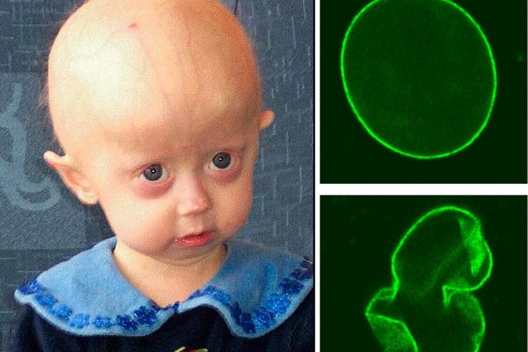 Progeria: o que é, causas, sintomas e tratamentos