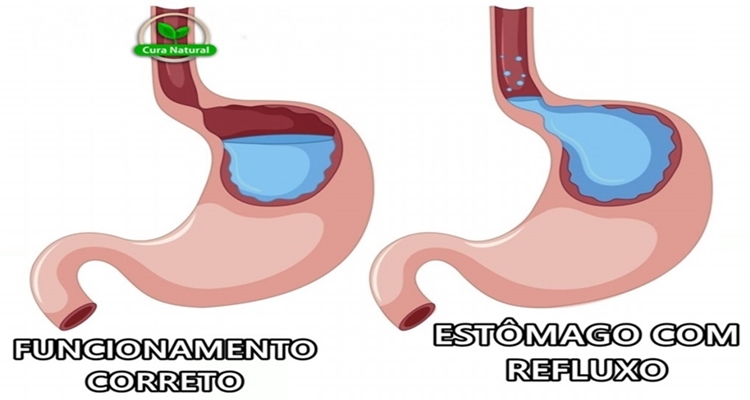 como acabar com o refluxo naturalmente