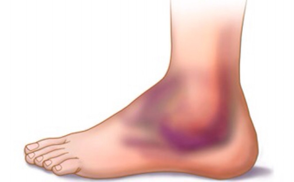 Remédios caseiros para tratar tornozelo torcido: como usar e receita