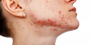 formas de usar tomate para tratar a acne