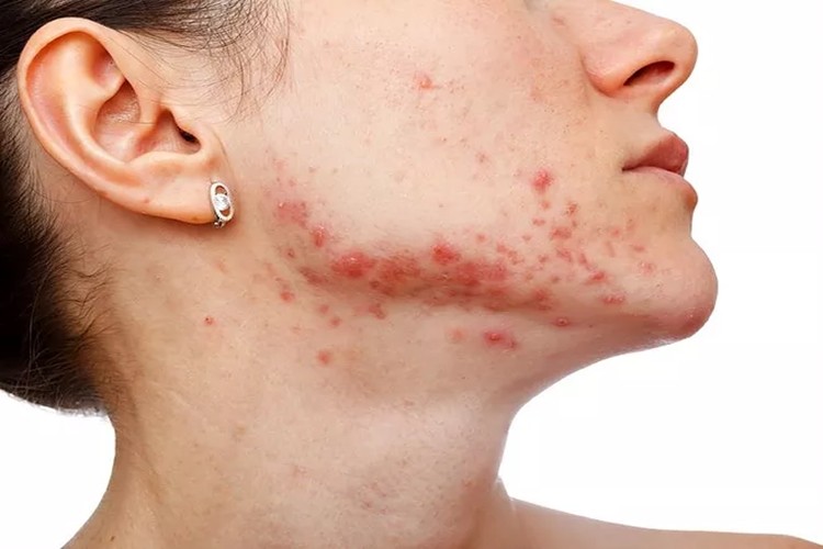 formas de usar tomate para tratar a acne