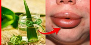 remedios caseiros para remover o inchaço nos labios