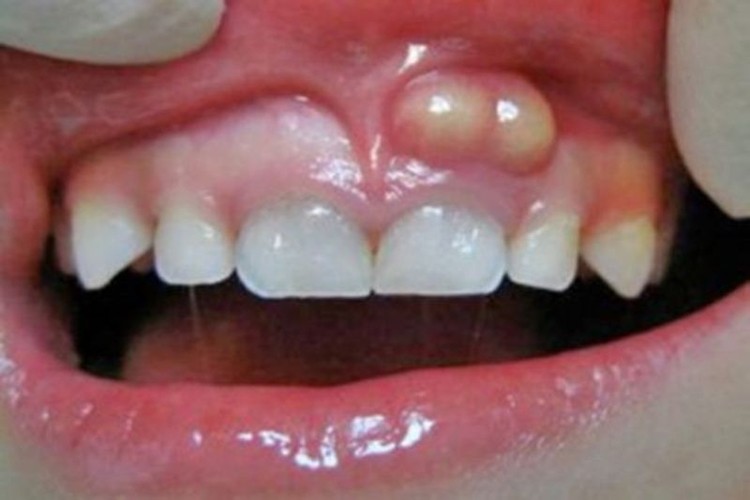 Remédios caseiros para tratar abscesso dentário: como usar, dicas e receitas