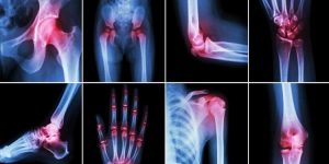 remédios caseiros para tratar artrite