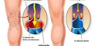 remedios caseiros para tratar varizes