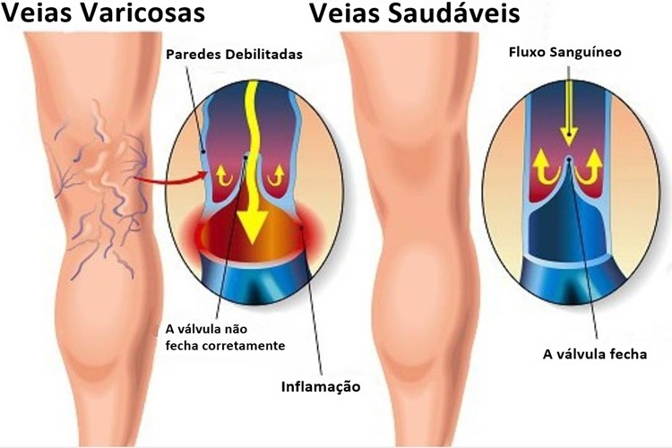 remedios caseiros para tratar varizes