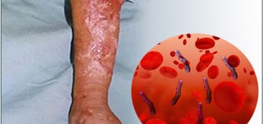 Septicemia - Oque é, Causas, Sintomas e Tratamentos! | Cura Natural