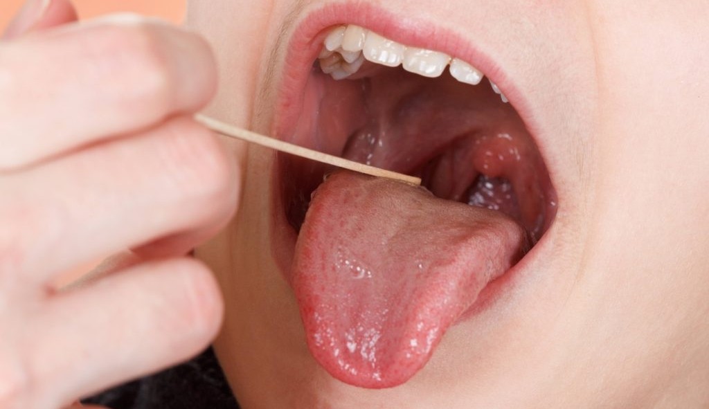 Síndrome da boca ardente: o que é, causas, sintomas e tratamentos