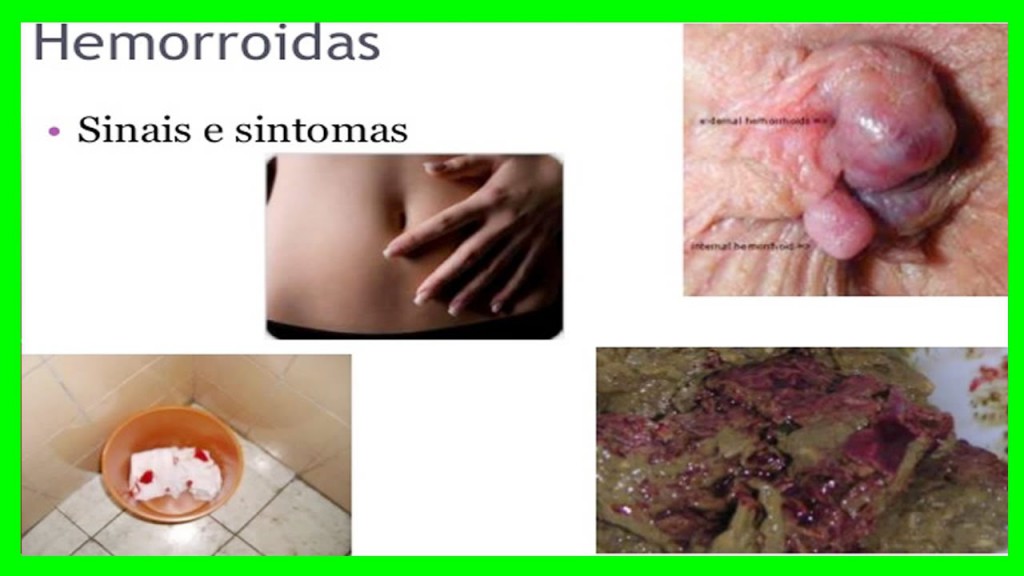 Hemorroidas: o que é, causas, sintomas e tratamentos