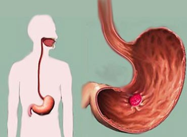 Úlcera gástrica: o que é, causas, sintomas e tratamentos