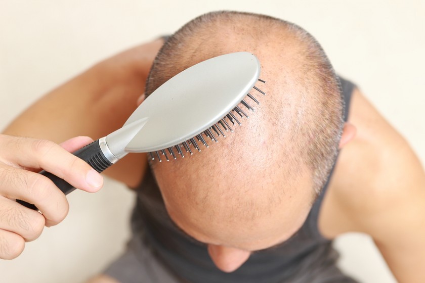 5 primeiros sinais de alopecia e como prevenir