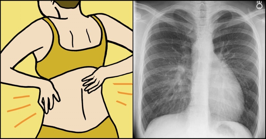 Câncer de pulmão: o que é, sintomas e tratamentos