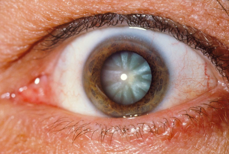 sintomas de glaucoma