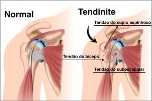 Tendinite: o que é, causas, sintomas e tratamentos