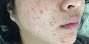 tipos de acne