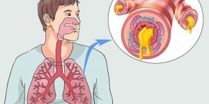 dicas de tratamento natural para bronquite