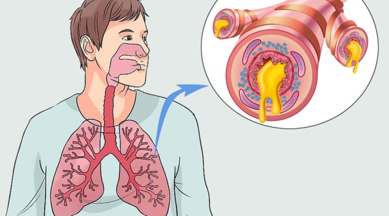 dicas de tratamento natural para bronquite