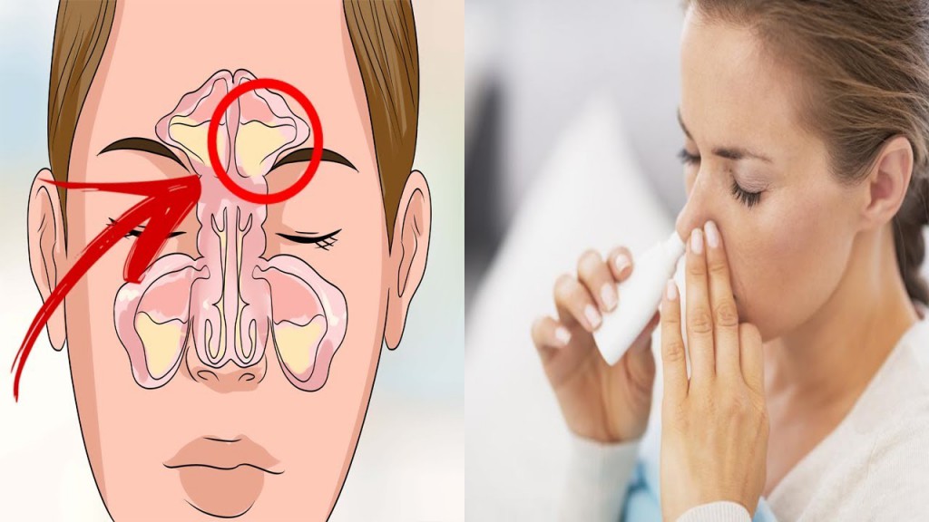 10 tratamentos naturais para nariz entupido: como fazer passo a passo