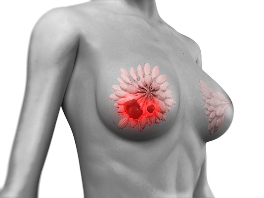 Câncer de mama: o que é, sintomas, causas e tratamentos