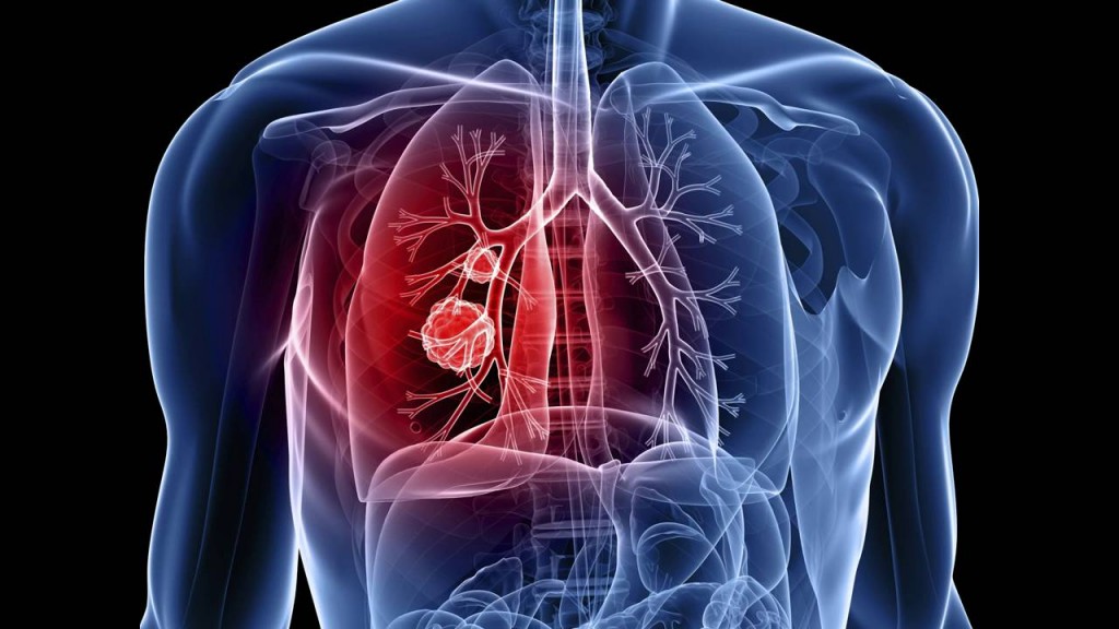 Tuberculose: o que é, causas, sintomas e tratamento