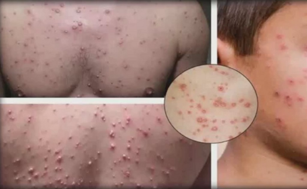 Os 5 sintomas da varicela e sinais para ficar em alerta